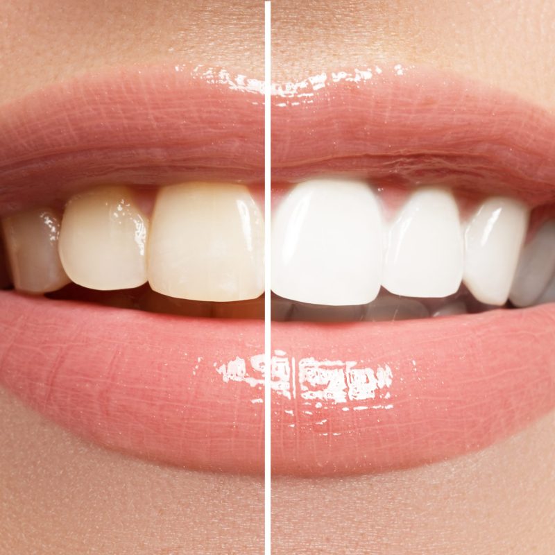 teethWhitening scaled