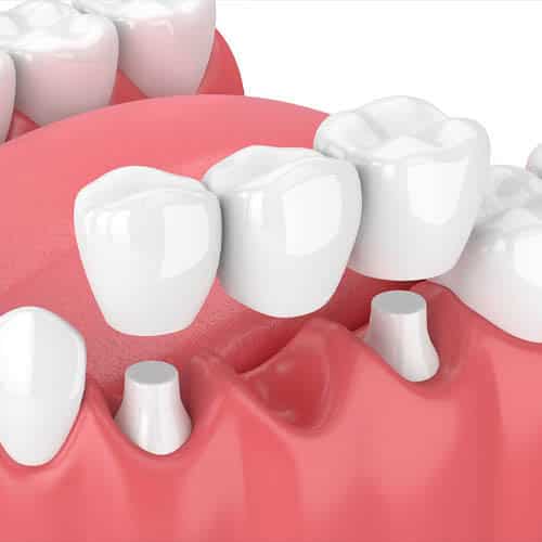 Dental Bridge at AFRA Dental Dental  Denti