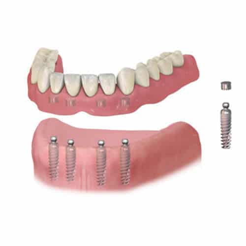 Implant Dentures at AFRA Dental Dental  De