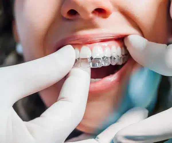 Invisalign in Baker ranch Dentistry and Implant Center Dentist in Corona
