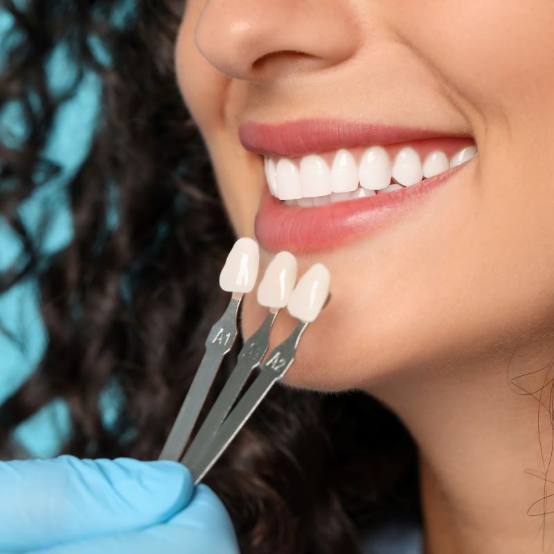 Veneers At AFRA Dental